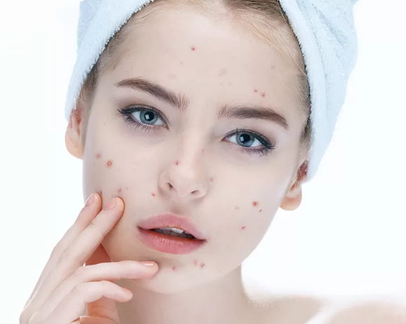 6 Simple and Effective Homemade Remedies to Get Rid of Acne and Pimples