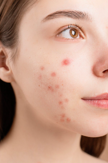 How to Heal Acne Scabs: 6 Effective Tips and Products
