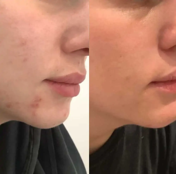 Is It Normal to Experience a Breakout After a Facial?