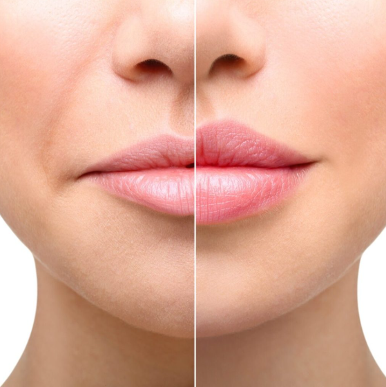 Understanding Lip Filler Swelling Stages: What to Expect During Recovery