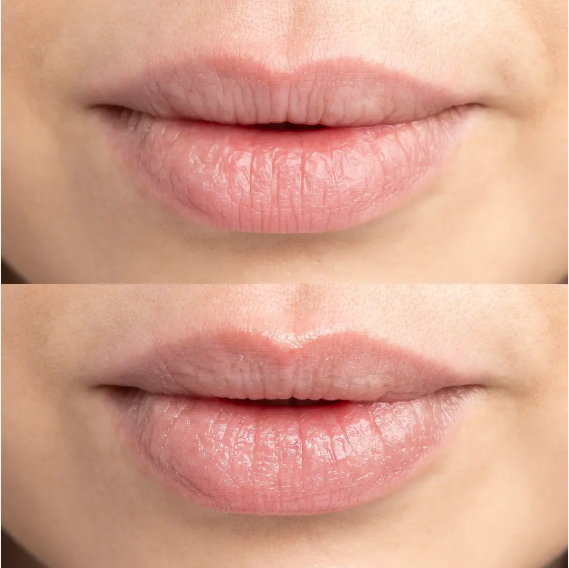 Dealing with Dry Lips During Pregnancy: Causes, Solutions, and Top Products
