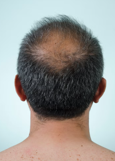 How Men Can Prevent Balding and Take Action Against Hair Loss