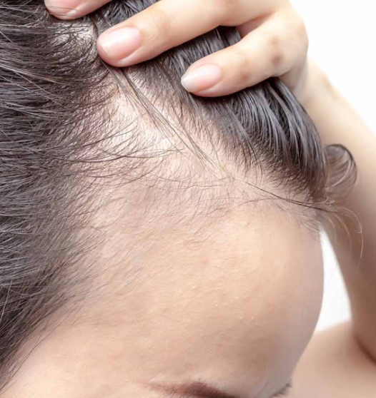 Are You the Right Candidate for a Hair Transplant in Turkey?